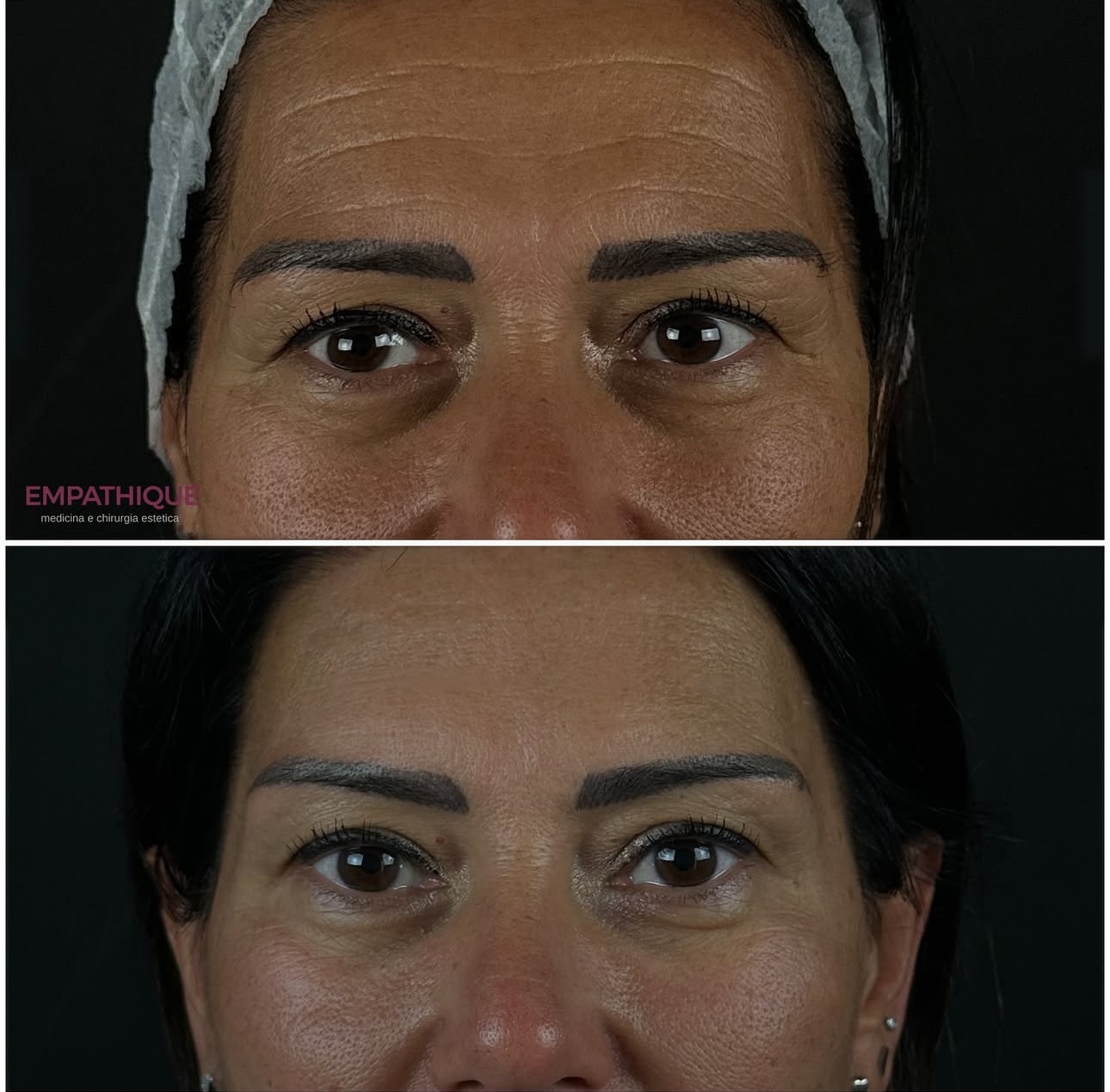 Botox